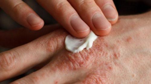 Tradiţii şi superstiţii. Leacuri băbeşti. Remedii naturiste pentru vindecarea rănilor