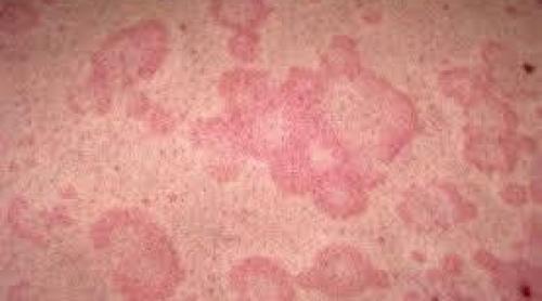 Urticaria afectează 15% din populaţia globului