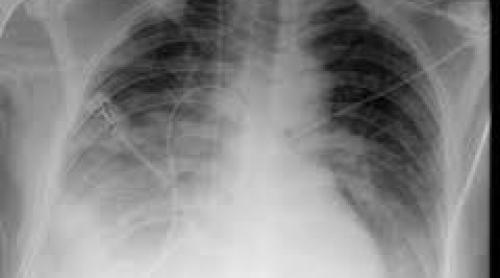 Pneumonia: Vârsta, un factor de risc