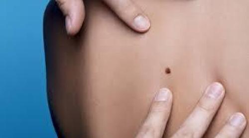 Mai mult de 11 aluniţe pe braţul drept, semn că ar putea fi aproape un cancer al pielii